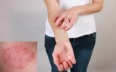 Treatment of fungal infections