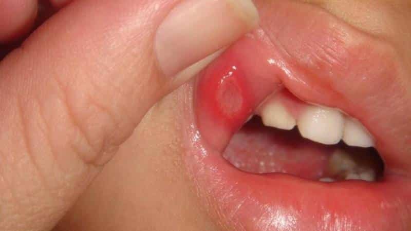 nego za ispiranje usta s stomatitisa kod djece