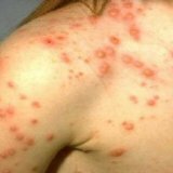 Treatment and symptoms of chicken pox in children