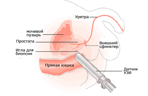 Shema-transrektalnogo-UZI-prostaty