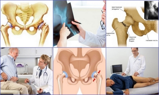 La osteoporosis de cadera: síntomas y tratamiento, causas, diagnóstico
