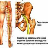 Causes of pinch of the sciatic nerve