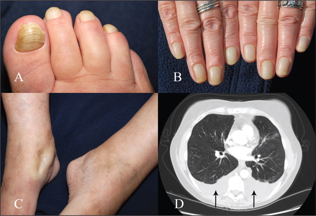 Sindrom žutog nokta: što je to, simptomi, uzroci i liječenje