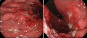 Esophagogastroduodenoscopisch onderzoek