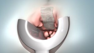 Vnútorné hemoroidy