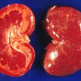 Interstitiell nefrit, symptom