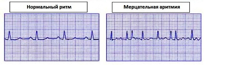 Elektrokardiogramm: transcript der Ergebnisse und Hinweise für