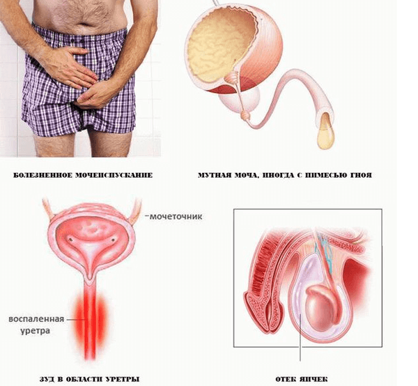 Uretritis klamidijska: simptomi, dijagnoza, liječenje