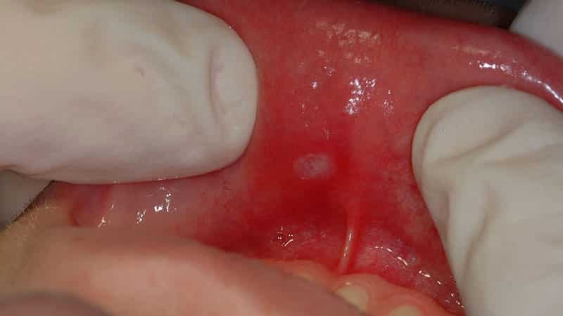 feridas brancas na boca