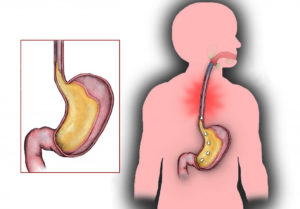A burning sensation in the esophagus