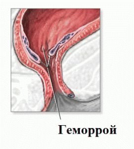 Intestinale aambeien