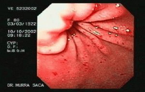 Antrum gastritis: wat is het, oorzaken, symptomen en behandeling?
