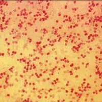 Meningococcal infection: symptoms and treatment