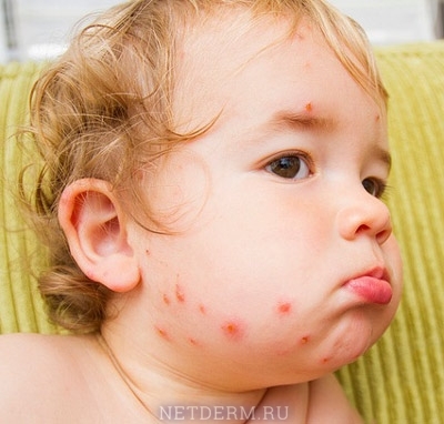 Chickenpox, chicken pox