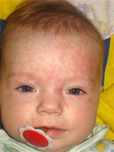 Roseola: causes