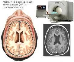Magnetresonanztomographie des Gehirns