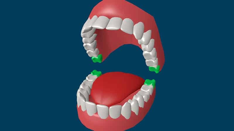 Verwijdering van verstandskiezen: 8 of te verwijderen van een tand pijn doet