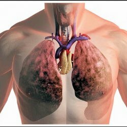Milyen betegségek kapcsolódnak a fertőző tüdőkárosodáshoz?