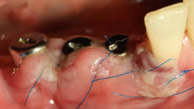 komplikaatioita istuttamisen jälkeen hampaiden kuva