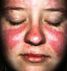 Symptomen van Lupus