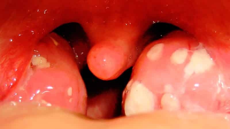 chronische Tonsillitis Foto