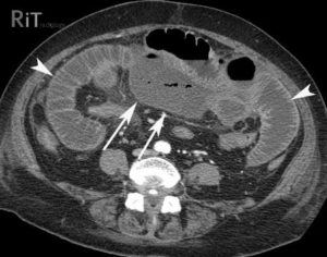 Bél ischaemia