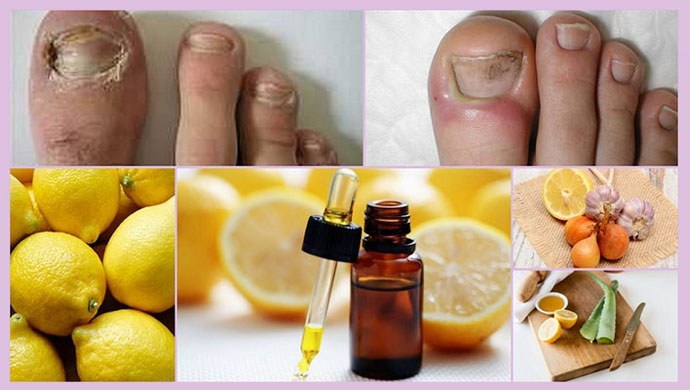 Citrons ar onihomikozi