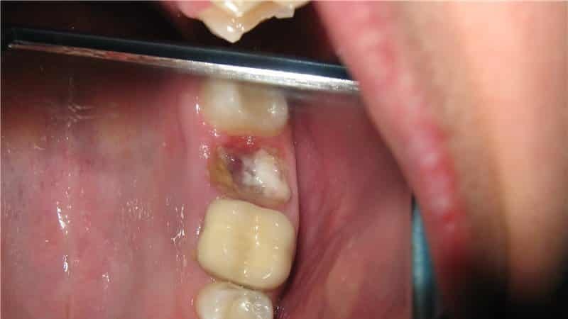 What can not be done after tooth extraction