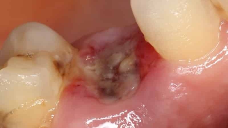 Complication after tooth extraction
