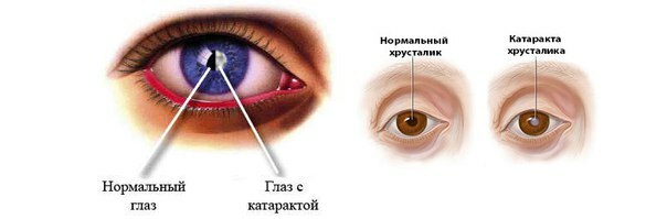 symptomen van cataract