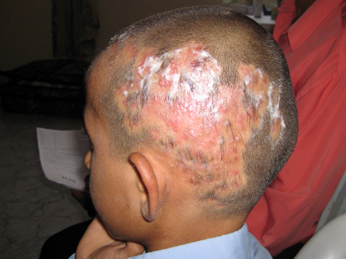 How to treat ringworm on the head