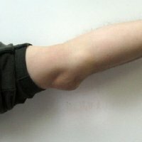 Bursitis zgloba koljena