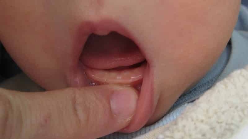 mulut jerawat bintik-bintik putih pada gusi pada bayi Foto