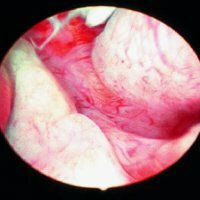 Glandular endometrial hyperplasia