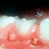 Abscess of gum tooth