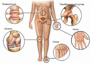 Oblasti postihnuté artritídou