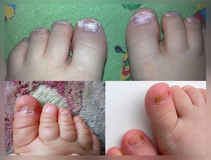 Fungus of toenails in children