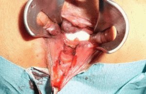 Procedimiento de hemorroidectomía