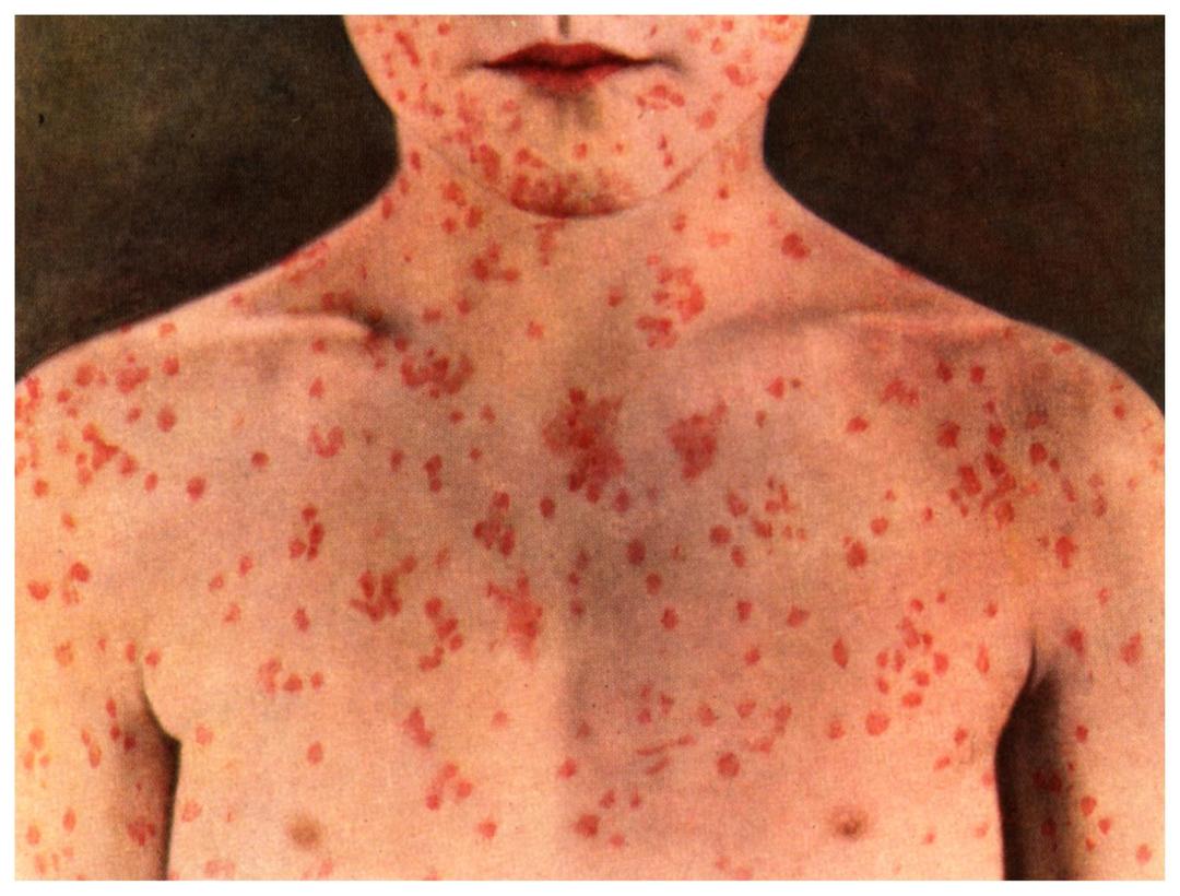 Red spots on the body of an adult, a child, a photo with a description