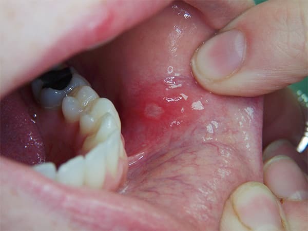 fond de cancer de la bouche
