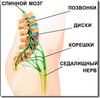 Causes of pinching the sciatic nerve
