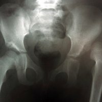Medfödd hip dislokation