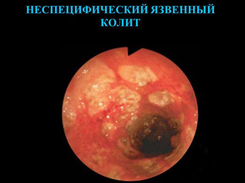 Nešpecifická ulcerózna kolitída