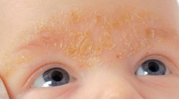 seborrhoeás dermatitisz gyermekek arcán