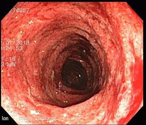 Colitis