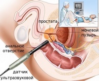 Ultrasound of the prostate helps to identify the stones