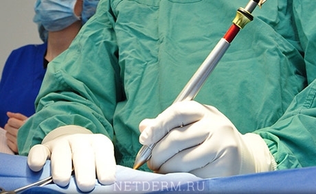 Laserová chirurgia
