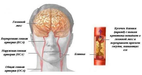 La aterosclerosis delicia de los vasos cerebrales, drogas