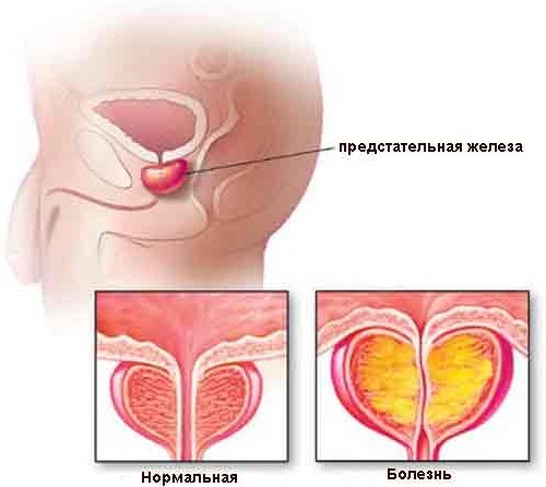 Was sind die Ursachen der Prostatitis und was sollte die Behandlung von