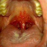 Akute Infektionen der Mundhöhle